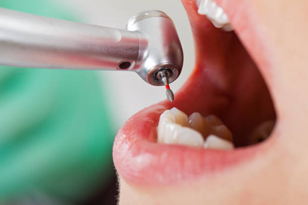 Best Emergency Dental Extractions in Rainier, WA